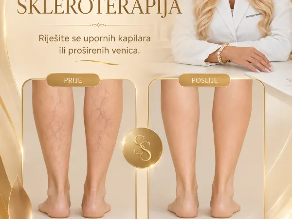 Skleroterapija