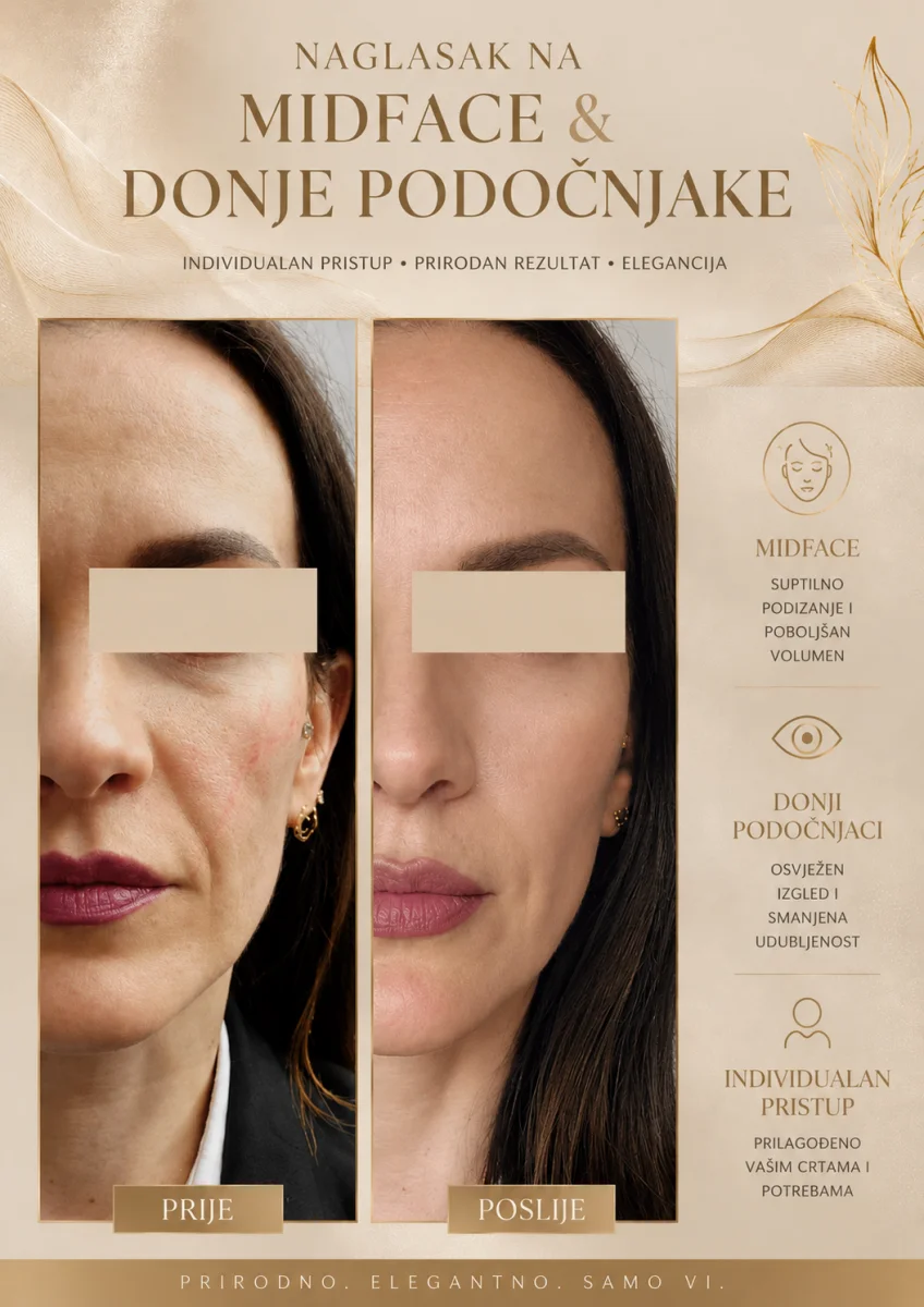 Naglasak na midface i donje podočnjake